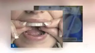 отбеливание зубов отзывы   - Как отбелить зубы дома