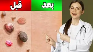 از بین بردن منگوله و زگیل های روی پوست به صورت طبیعی در خانه - Skin tags