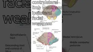 infarction of pons (medial and lateral pons) #shorts