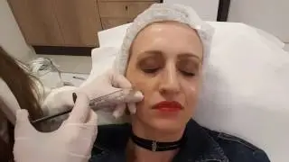 FUI FAZER BOTOX E PREENCHIMENTO- VEJA NO QUE DEU!