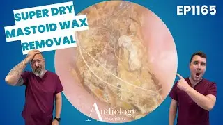 Extreme Dry Skin & Ear Wax in Mastoid Cavity Cleared! - EP1165