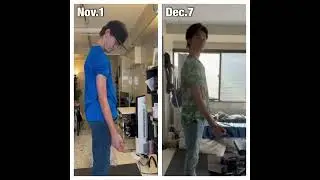 FSHD after 5 weeks of treatment #fshd #musculardystrophy