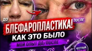 Блефаропластика до /после , мой опыт 