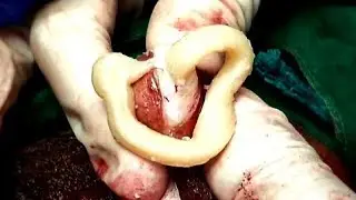 Treatment of Scrotal Cyst(अंडकोष पर गांठ) No. 88 popped one cyst.