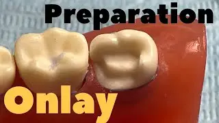 Onlay Preparation