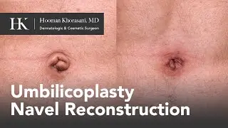 Umbilicoplasty, belly button revision surgery by Dr. Khorasani | Quadruple Board-Certified Surgeon