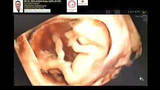 Fetal development 11-15 weeks (Voluson E22)