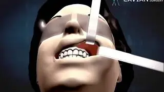 Phương pháp hạ xương gò má của bệnh viện thẩm mỹ Lavian   Bệnh viện thẩm mỹ hàng đầu về hàm mặt
