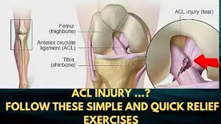 ACL Injury? ohh do these simple exercises..quick relief grade1&2 @ACLtear WITHOUT SURGERY.