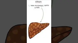 Stages of Non-Alcoholic Fatty Liver Disease 