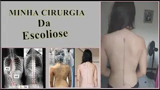 MINHA CIRURGIA DA ESCOLIOSE