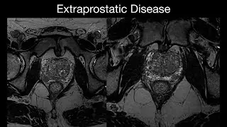 Extraprostatic Disease