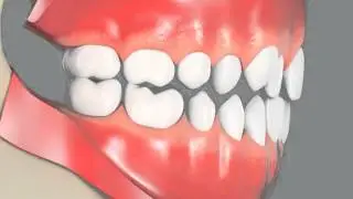 Crowding No Braces (Lateral View)