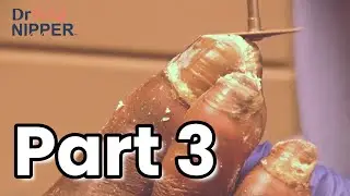 What causes thick toenails? | Part 3.  The Story Continues to an End.  Friday FEET-ure (2021)