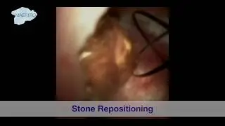 Stone Repositioning
