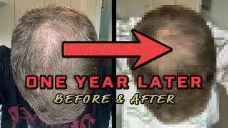 Before & After: My hair transplant one year later