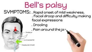 What Causes BELL'S PALSY - Bell’s Palsy Explained - Symptoms - Cause - Complications - Treatment