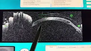 Using OCT Technology To Evaluate A Scleral Lens On Eye After EpiLASIK On Eye With Corneal Transplant