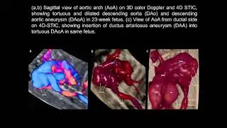 Fetal descending aortic tortuosity with ductal aneurysm