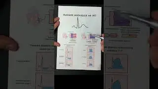 Ишемия миокарда на ЭКГ