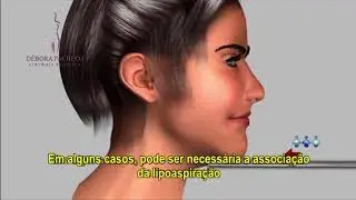 LIFTING FACIAL - Dra. Débora Tomatis Pacheco - Cirurgia Plástica - Porto Alegre/RS
