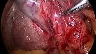 Laparoscopic Cholecystectomy using only basic instruments - Maryland forceps l Dr Subhadip Sarkar