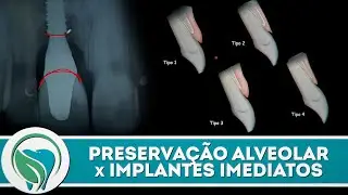 Preservação Alveolar x Implantes imediatos