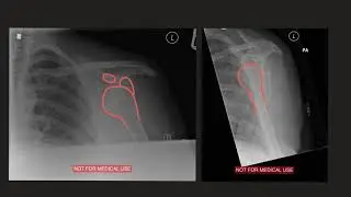Shoulder dislocation