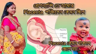 প্লাসেন্টা দেখে কি করে বুঝবেন ছেলে না মেয়ে  হবে ।baby placenta position থেকে baby gender ।