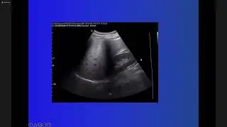 Một số bệnh lý gan hay gặp trên siêu âm - Siêu âm tổng quát YHN