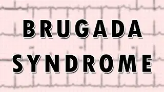 Brugada syndrome