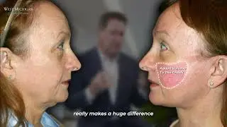Facelift - Dr Scott Holley - #beforeafter #facelift #neck