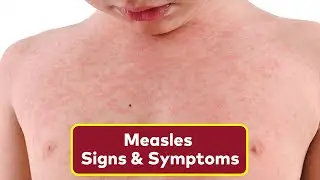 The 3 Warning Signs of Measles To Look Out For | How To Spot Measles Rash.