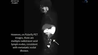 PSMA PET/CT PYLARIFY   Case 2