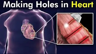 Transmyocardial Revascularization: A treatment option for Angina Patients (3d animation)