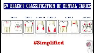 GV Black's Classification of Dental Caries