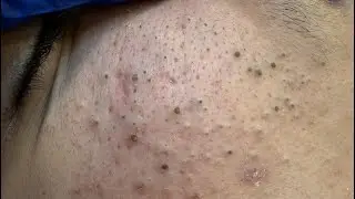 ASMR Satisfying Pimple Popping & Acne Treatment Techniques