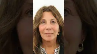 20 years younger with a Vertical Deep plane facelift surgery #facelift