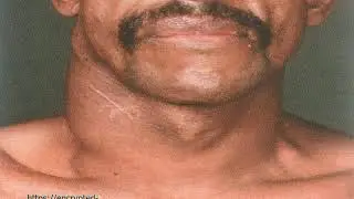 Lecture 3 lymphoma (internal medicine)