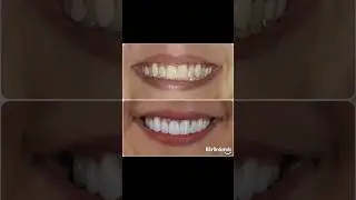 Ten upper porcelain veneers for a STUNNING transformation!! 🤩#shorts
