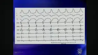 Intracardiac EP Tracings