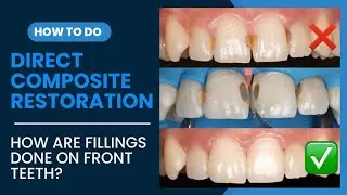 Treating Cavities On Front Teeth, How painful is a front tooth filling, Direct Composite Restoration
