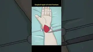 Repair of wrist fracture