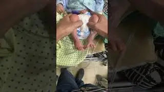 Barlow and ortolani maneuvers for developmental dysplasia of hip joint in a neonate.