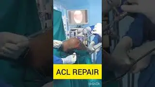 Laparoscopic Gall Bladder Stone Surgery ✨