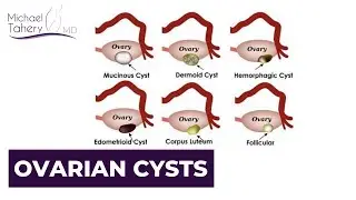 Types Of Ovarian Cysts | Los Angeles | Dr Michael Tahery