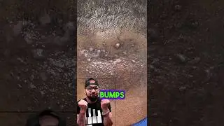 Bumps In Back Of NECK Solution ‼️👨🏽‍🔬