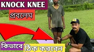 How To Solve Knock Knee Problem | নকনী পবলেম কীভাবে ঠিক করবেন ।