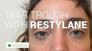 Treat dark circles under eyes with dermal filler  in Seattle at Well Medical Arts