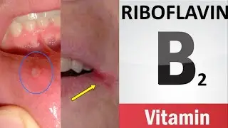 Vitamin B2 (Riboflavin) deficiency symptoms, food sources and benefits of the B2 vitamin